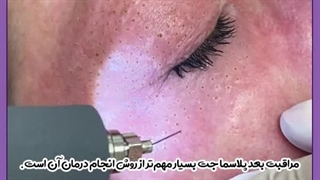 مراقبت بعد از پلاسما جت لمینت