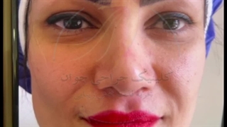 فیلم جراحی بلفاروپلاستی پلک بالا