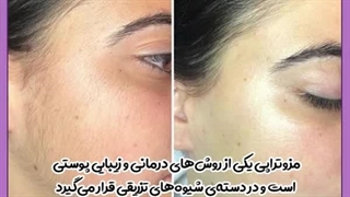 مزوتراپی کامپوزیت ونیر