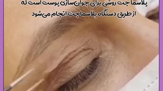 پلاسما جت اکستنشن تاج دندان