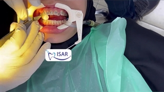 مراحل ارتودنسی دندان (فیلم) در مرکز تخصصی ارتودنسی دندان تهران(ایثار کلینیک)