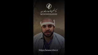 انتخاب کاشت مو به روش SUT کاشت ریش