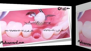 بریج دندان (پل دندان)