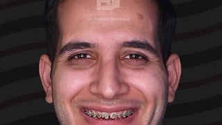 جراحی همزمان فک و چانه