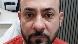 تزریق  فیلر و لیفت صورت در کرج