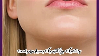 پروتز چانه زاویه سازی صورت