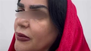 اصلاح فرم صورت با کمترین میزان فیلر!