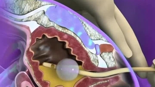 قرار دادن سوند فولی – نحوه انجام و نکات مهم