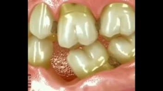 شماتیک عوارض عدم جایگزینی دندان از دست رفته