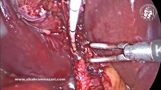 اندازه‌گیری باقیمانده مجرای کیسه صفرا