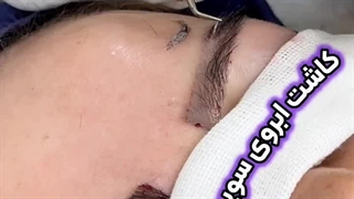 کاشت ابروی طبیعی در کلینیک زیبایی رنسانس