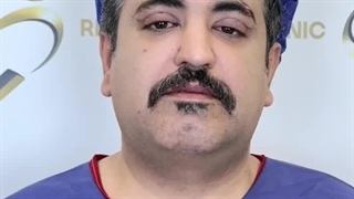 انجام بلفاروپلاستی پلک بالا در کلینیک زیبایی رنسانس