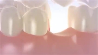 فیلم انیمیشن کاشت ایمپلنت