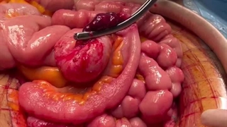 جراحی سرطان رکتوم